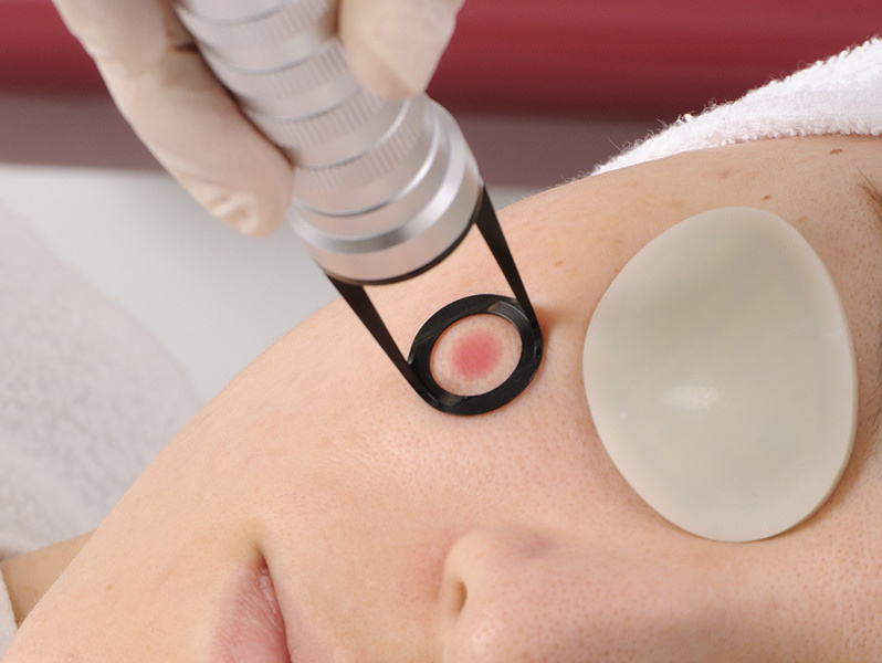 しみやあざを取るQスイッチレーザー