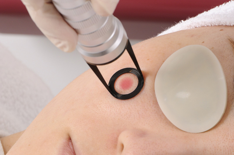 Qスイッチレーザー