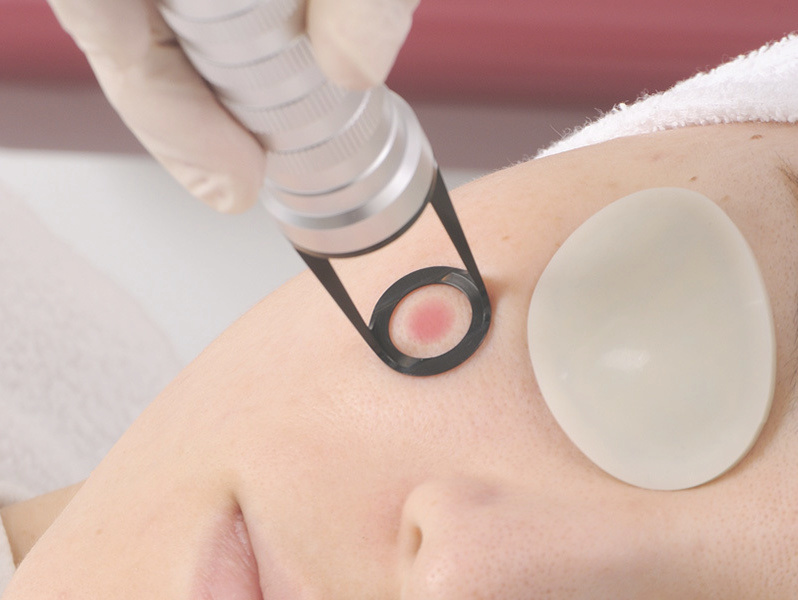 しみやあざを取るQスイッチレーザー