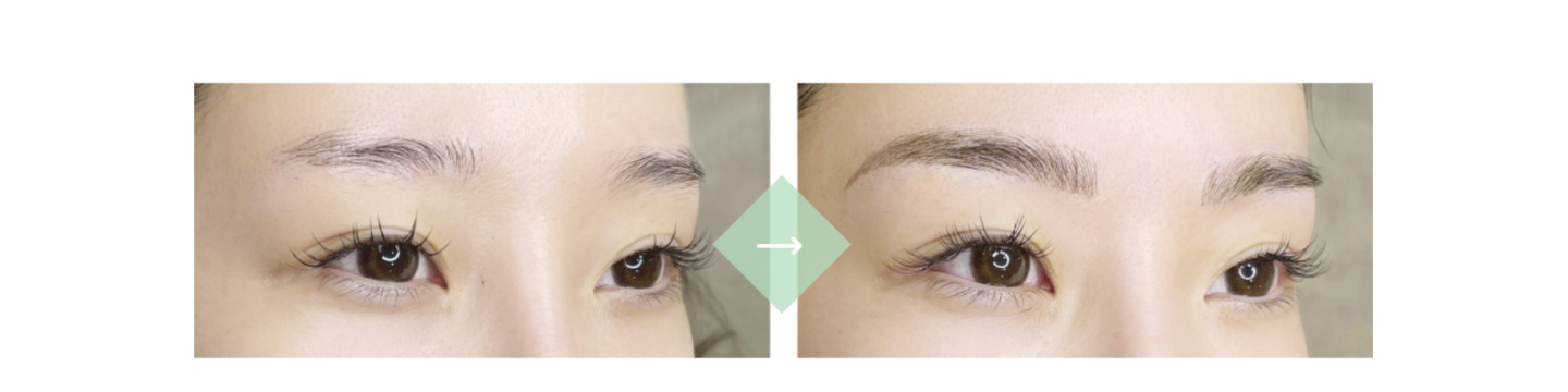 施術例１[before→after]