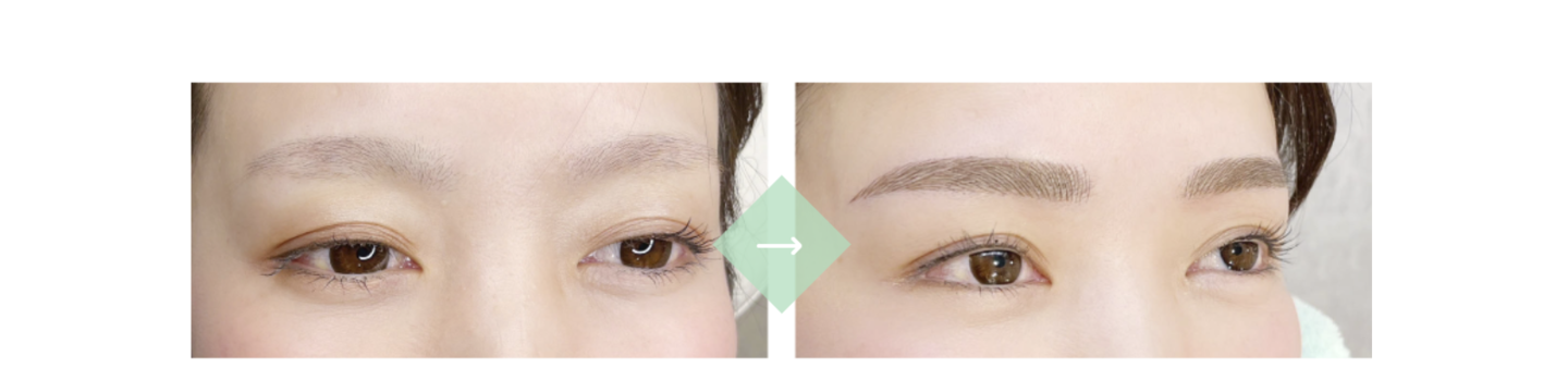 施術例２[before→after]