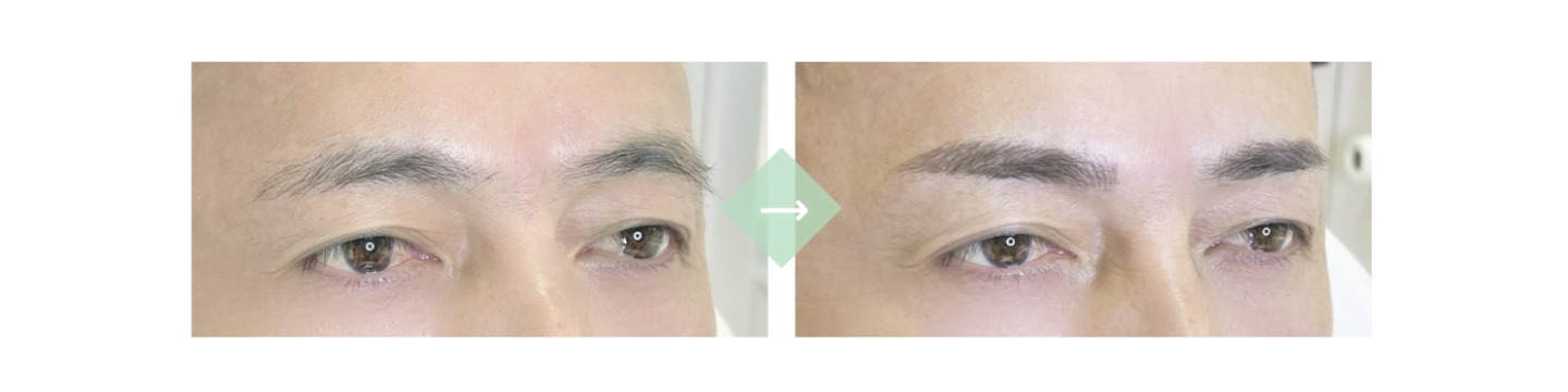 施術例３[before→after]