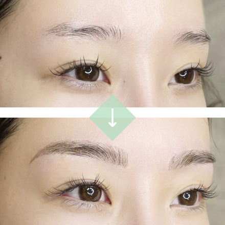 施術例１[before→after]