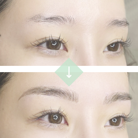 施術例１[before→after]