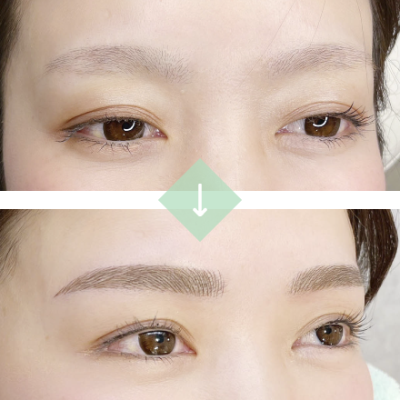 施術例２[before→after]